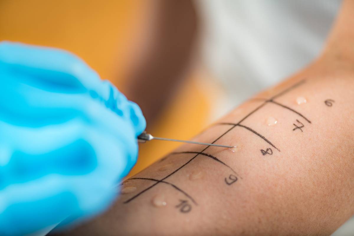 What Are the Different Types of Allergy Tests?